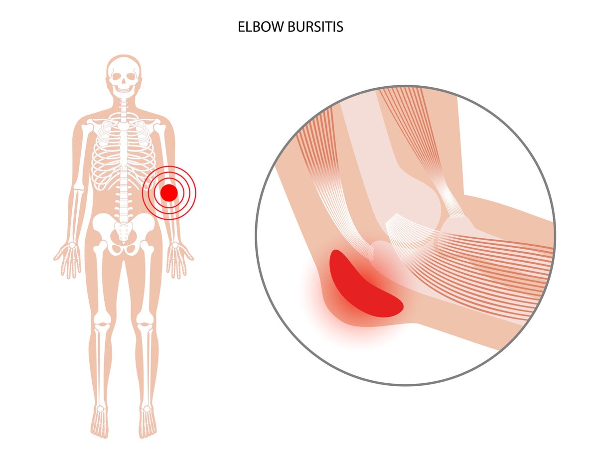 Can you exercise after PRP injections