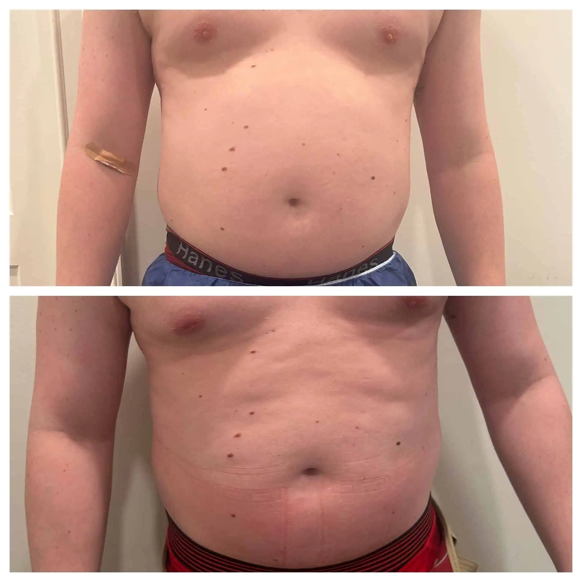 Bliss Diode Laser Treatment 1 Body Sculpting Laser Treatment Before and After