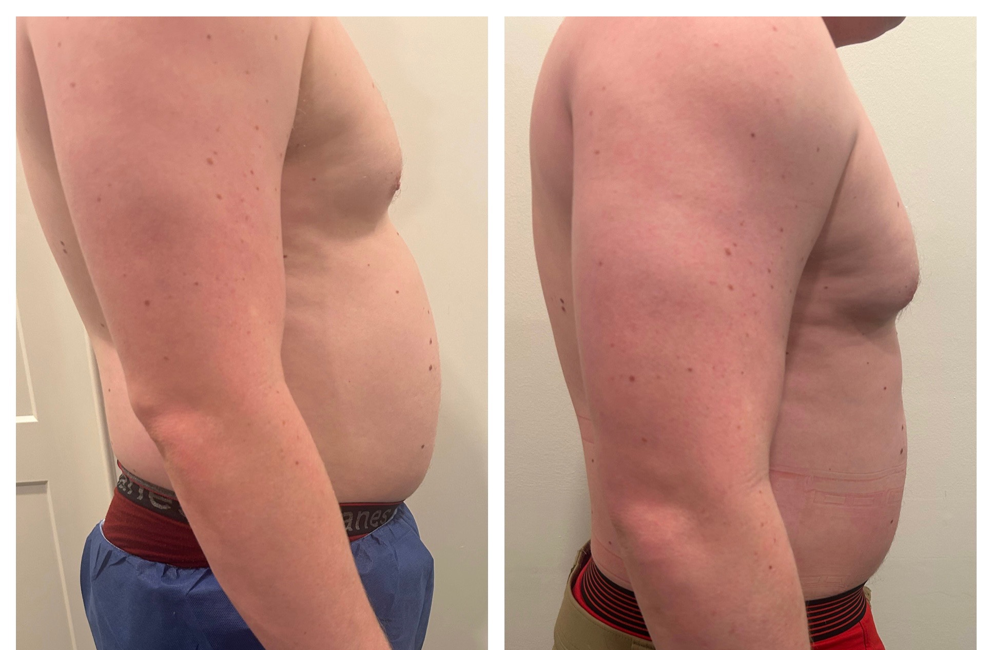 Bliss Diode Laser Treatment 2 Fat Burner Laser Treatment Before and After