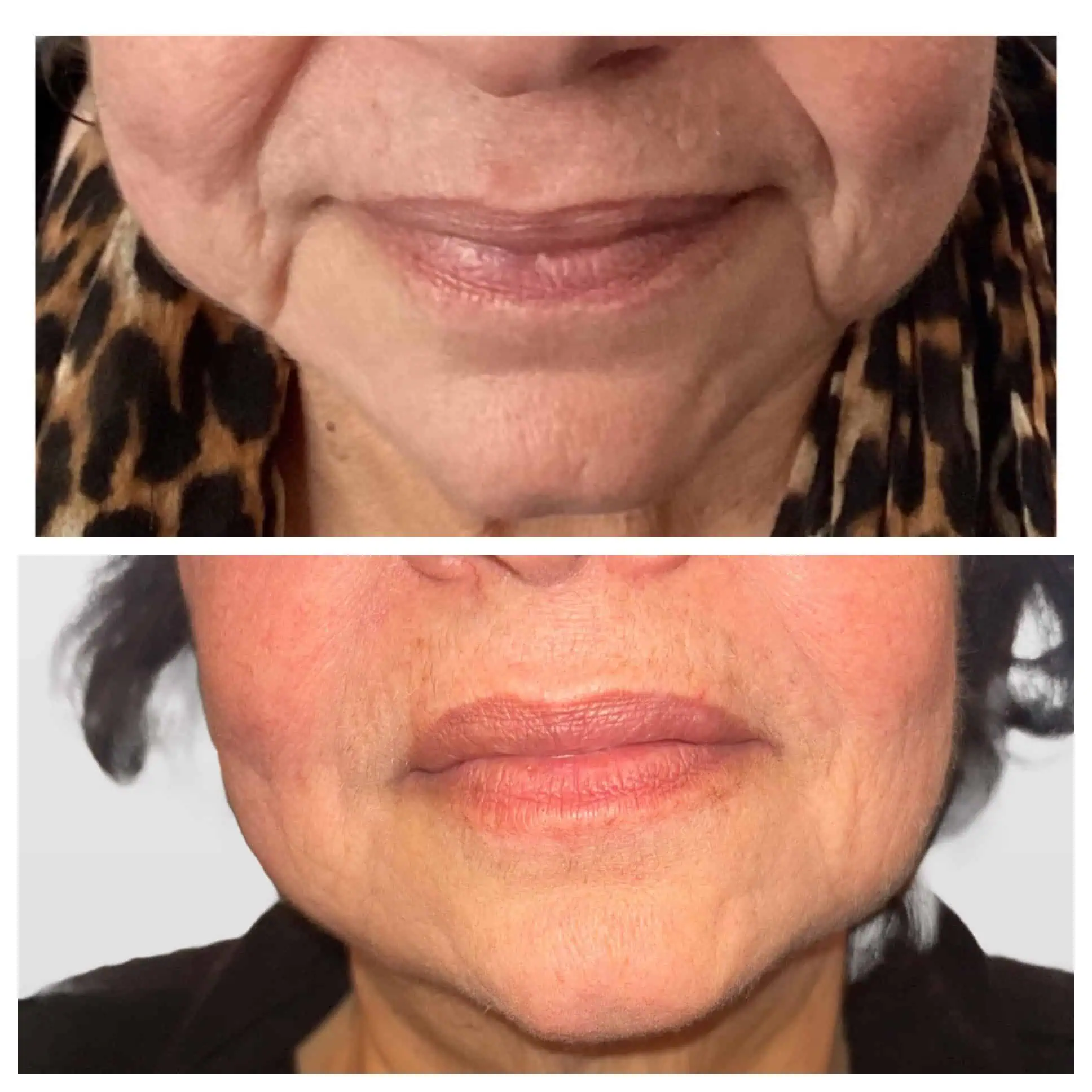 Cheek Filler 1 Cheek Filler with Nasolabial Folds Lips and Pyriform