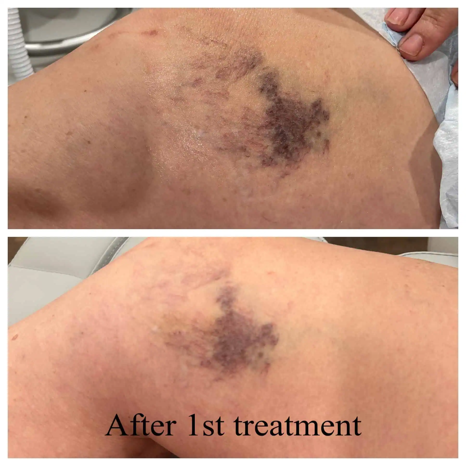 IPL Treatment Before and After