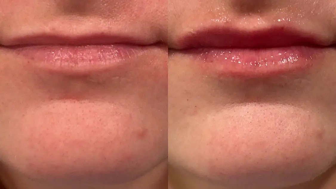 Lip Filler 5 Lip Filler 1x Restlylane Kysse