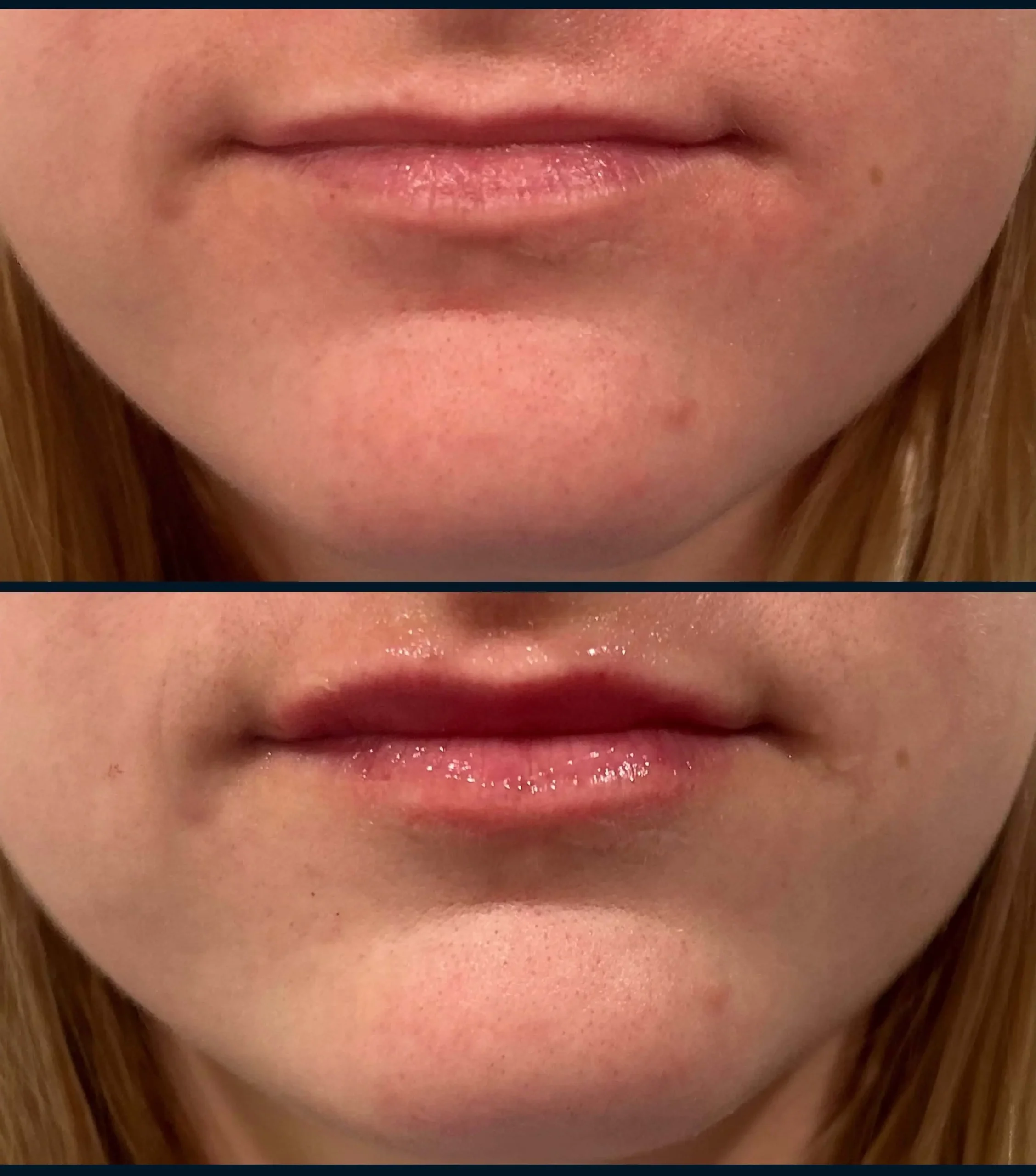 Lip Filler 3 Lip Filler 1x Restylane Kysse