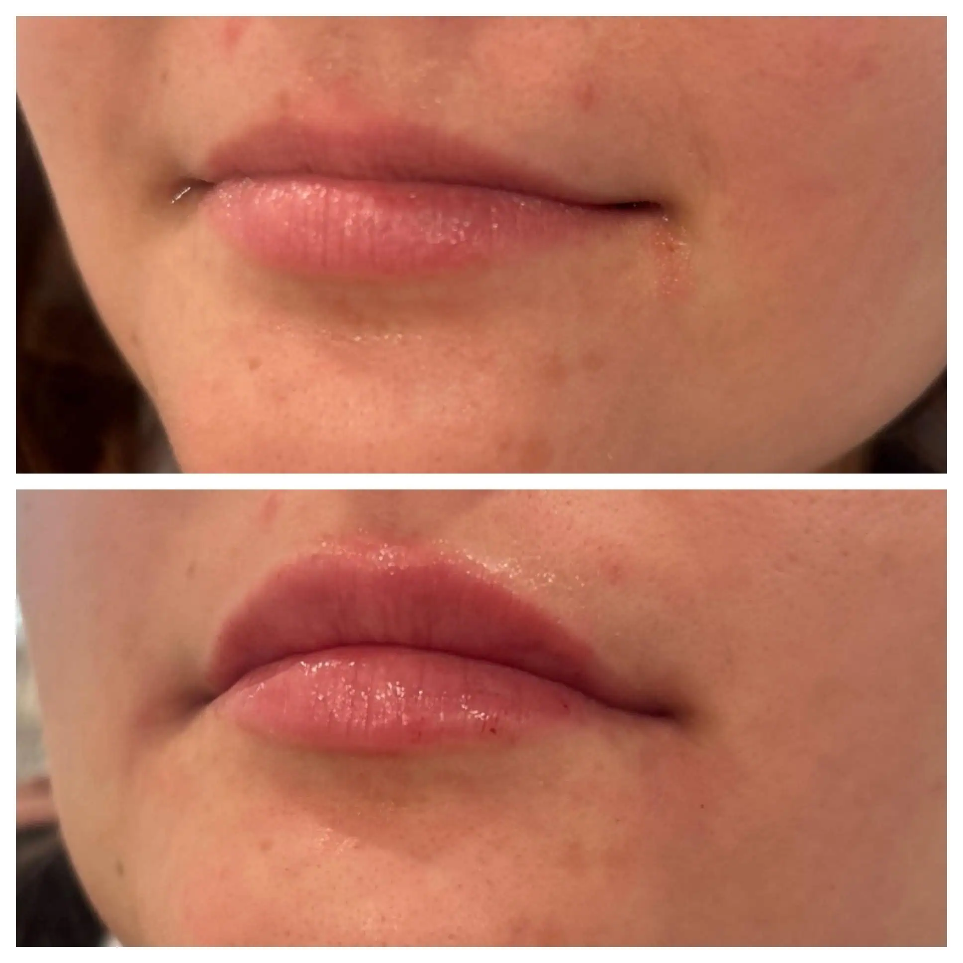 Lip Filler 1 Lip Filler 1x Restylane Kysse