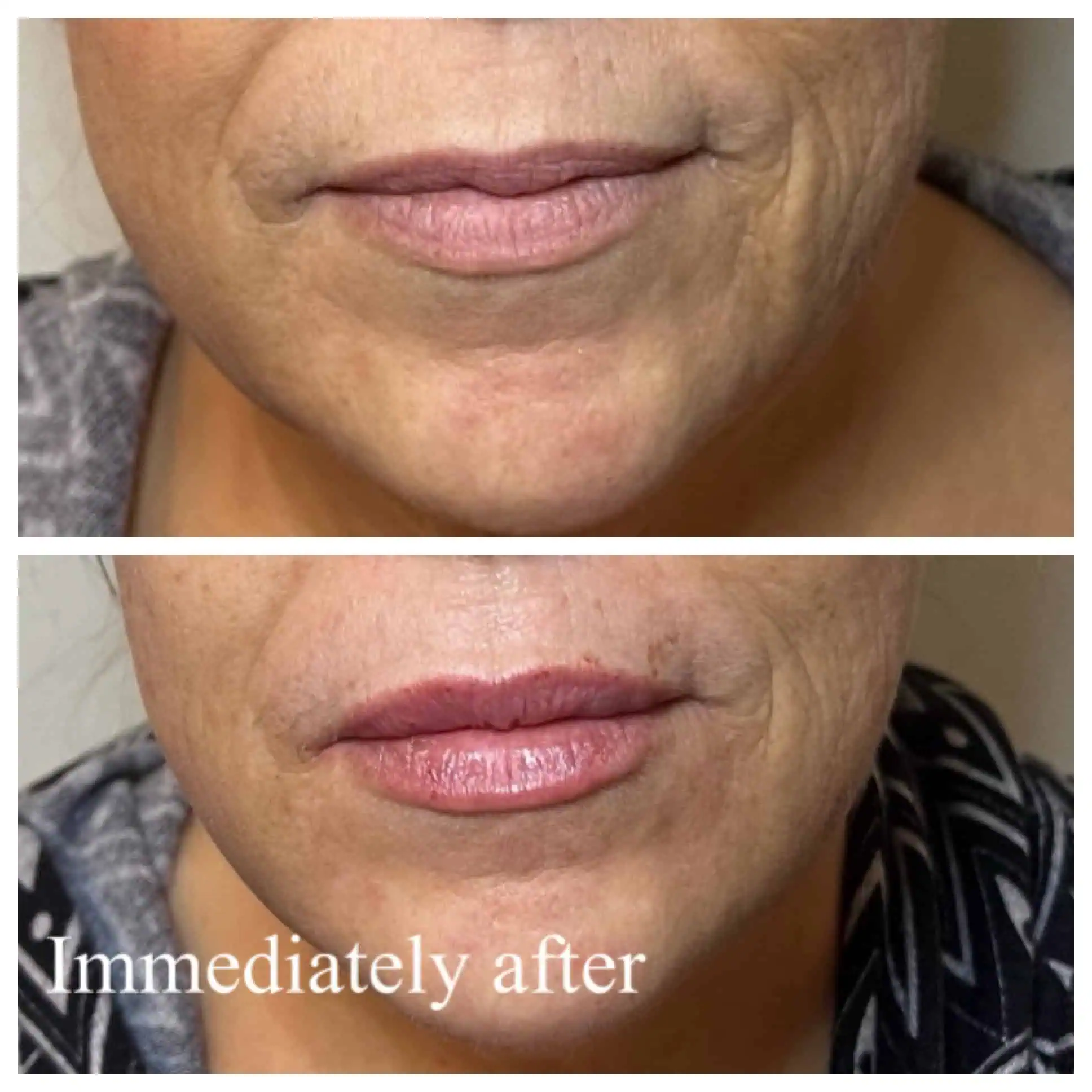 Lip Filler 2 Lip Filler Restylane Kysse