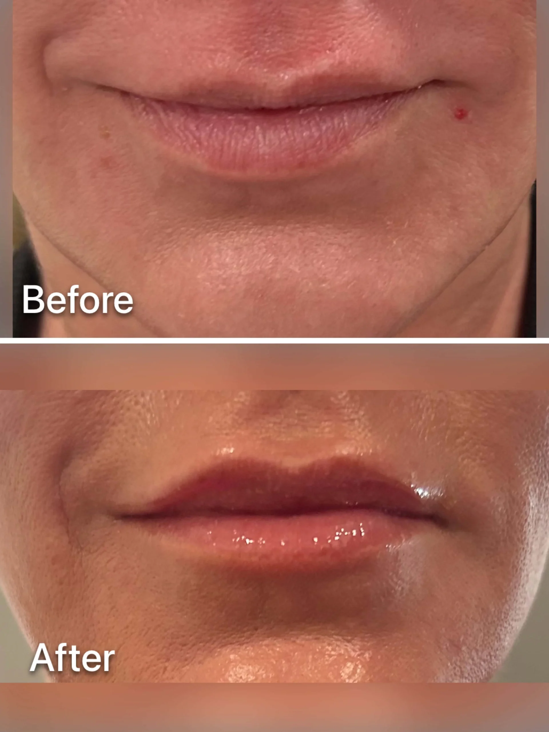 Lip Filler 4 Lip Filler Restylane- L