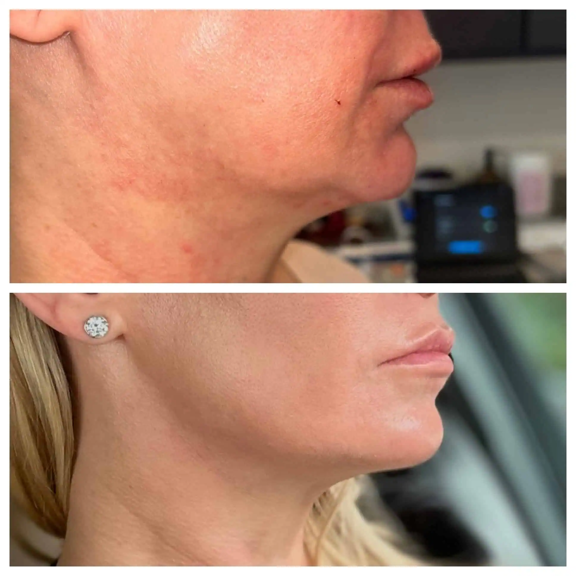 Nefertiti Lift 1 Lip Filler Before and After