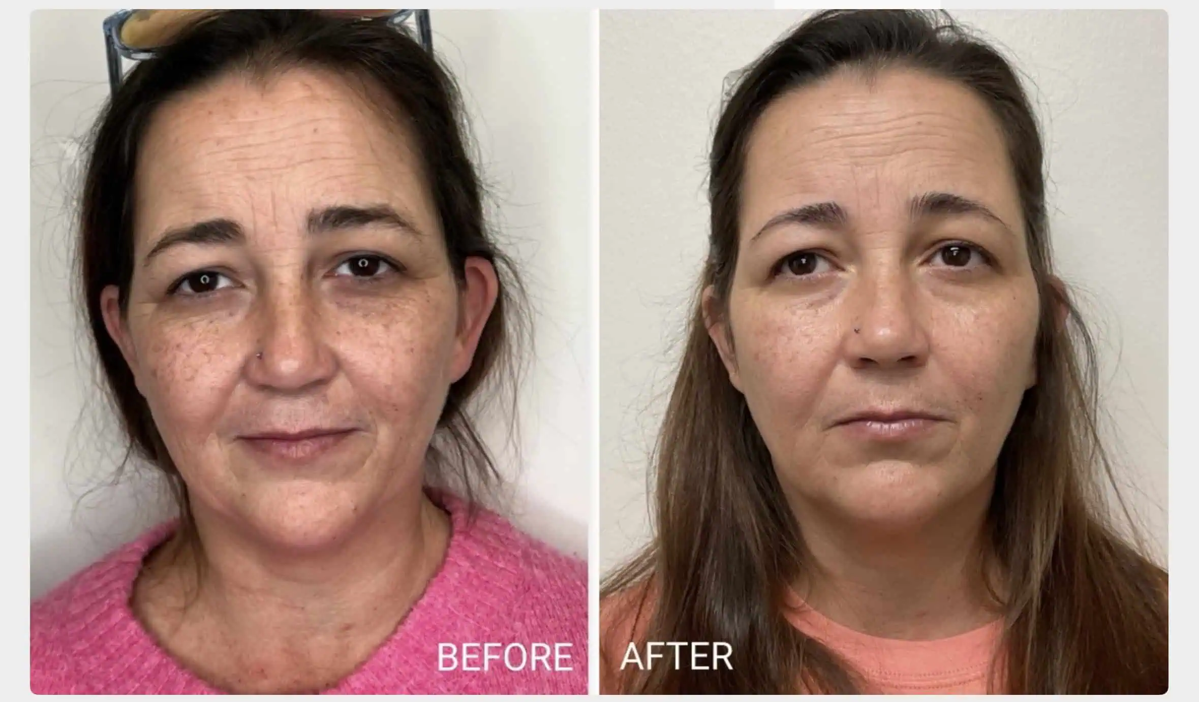 Sculptra Treatment Before and After