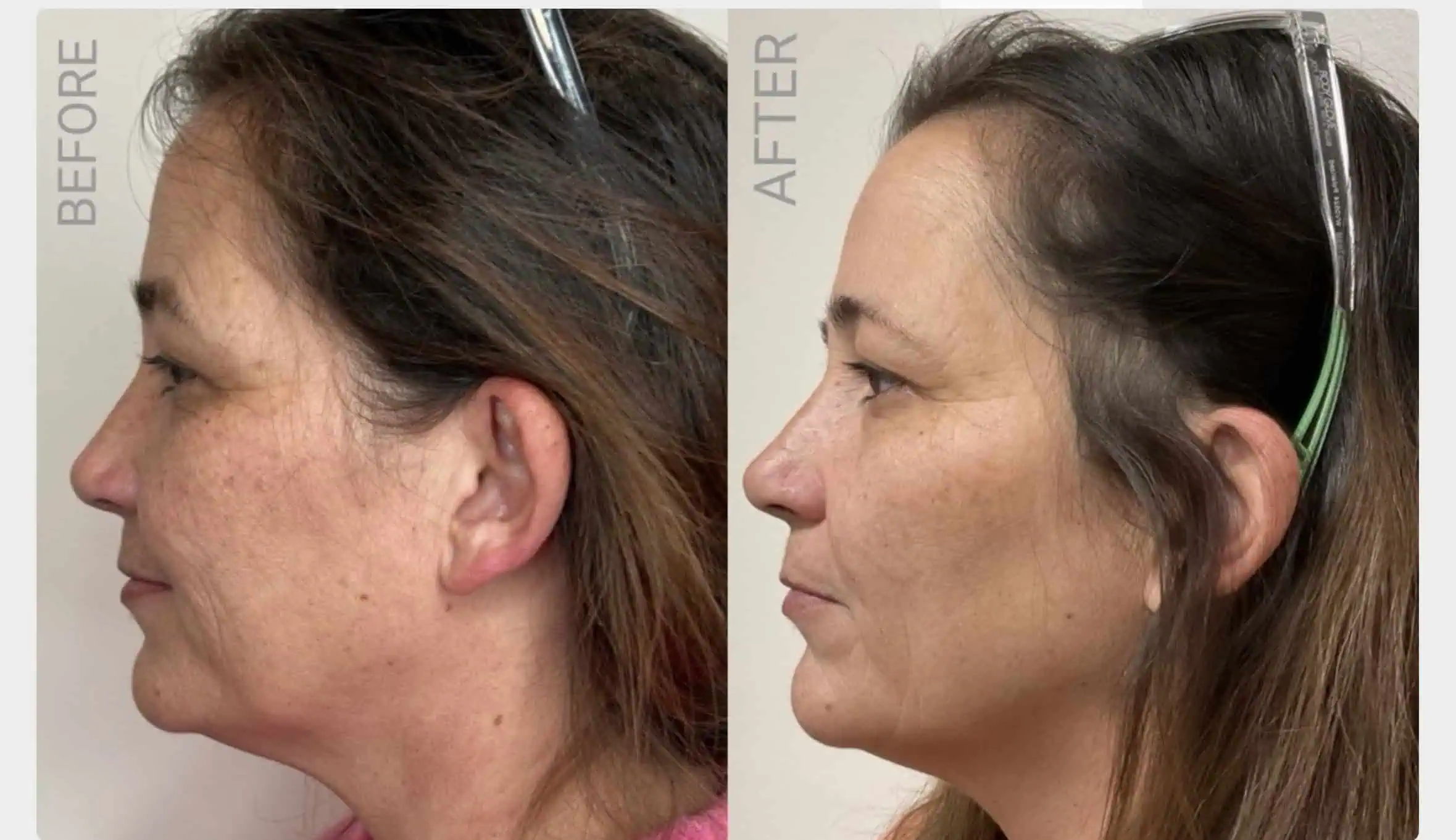 Sculptra Before and After