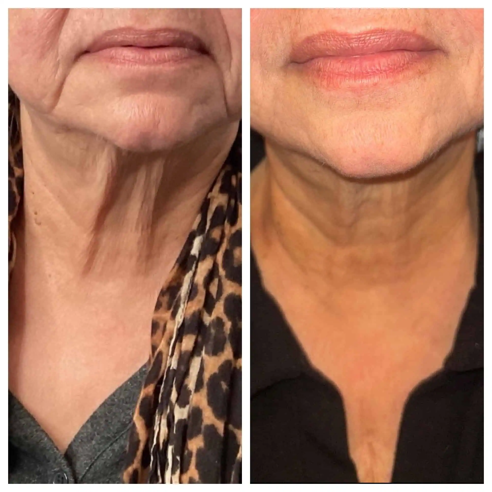 VIVA Treatment 1 Neck Lift Before and After
